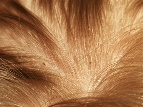 Spotting Hair Nits: Recognizing Indications and Symptoms