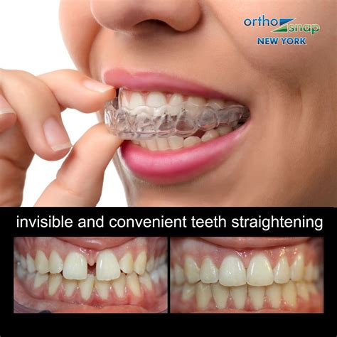 Straighten Your Teeth Without the Metal: The Advantages of Invisible Braces