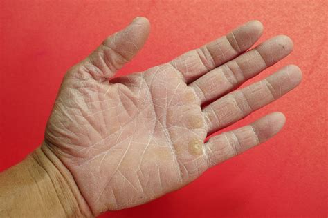 Strategies for Dealing with Dreams Involving Shedding Skin from Hands