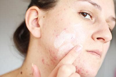 Strategies for Minimizing Permanent Skin Damage: Preventing Acne Scars