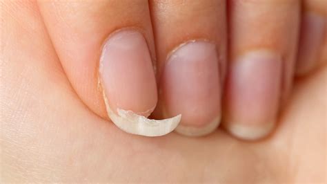 Strategies for addressing underlying issues associated with damaged nails in dreams