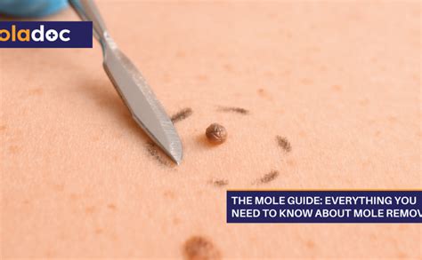 Surgical Mole Excision: What You Need to Know