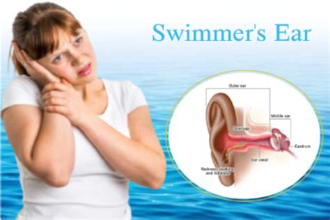 Swimmer's Ear: How Water Exposure Can Cause Ear Swelling