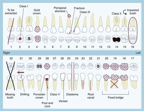 Symbols and Meanings: Decoding the Significance of Dental Crown Loss in Dreams