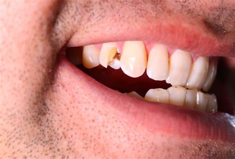 Teeth Dreams: Can They Indicate Health Conditions?