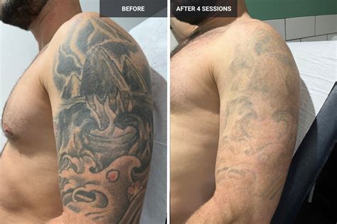 The Advantages and Disadvantages of Laser Tattoo Removal