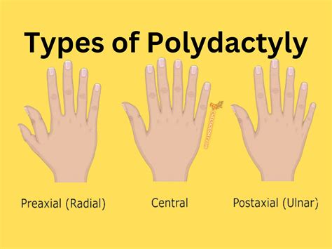 The Astonishing Wonders of Polydactyly: An Exceptional and Uncommon Abnormality