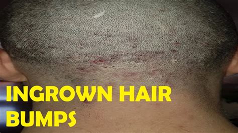 The Basics of Unwanted Hair Bumps