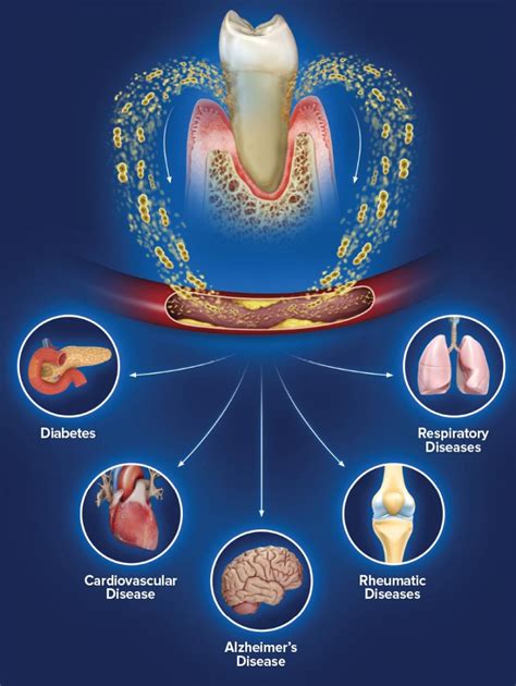 The Connection Between Inadequate Oral Care and Gum Infections