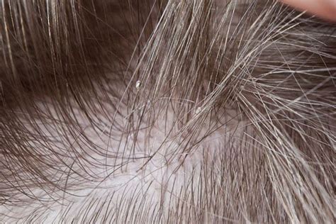 The Consequences of Ignoring Lice Eggs: Potential Impact on Health and Social Well-being