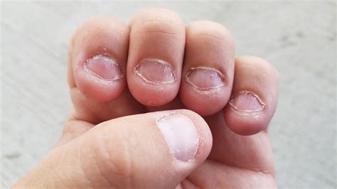 The Detrimental Effects of Nail Biting on Psychological Well-being