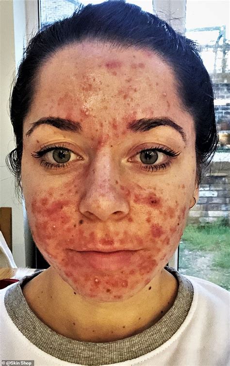 The Empowering Effect of Confronting Enormous Pimples