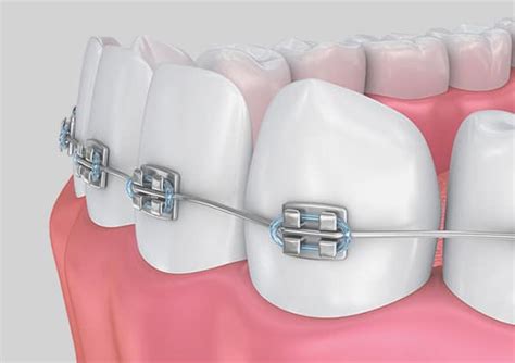 The Enchantment of Orthodontics: Exploring Society's Preoccupation with a Perfect Smile