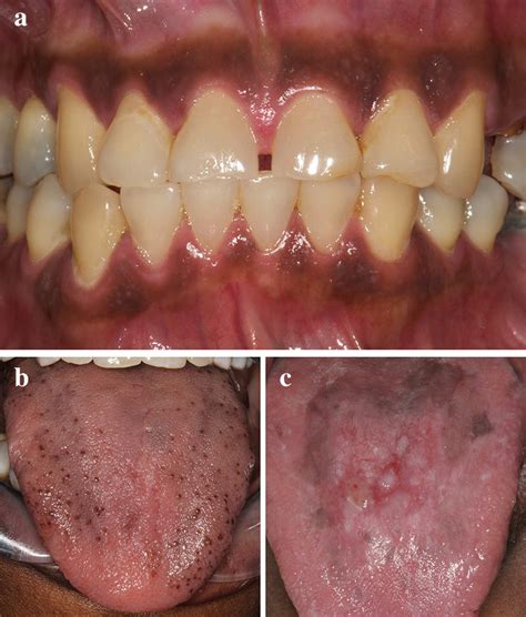 The Enigmatic Symbolism of a Dark-Skinned Oral Organ