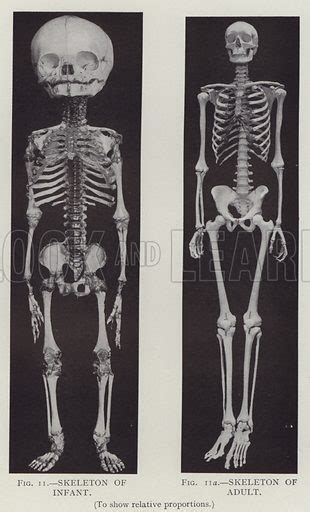 The Enigmatic Vision of an Infant Skeleton