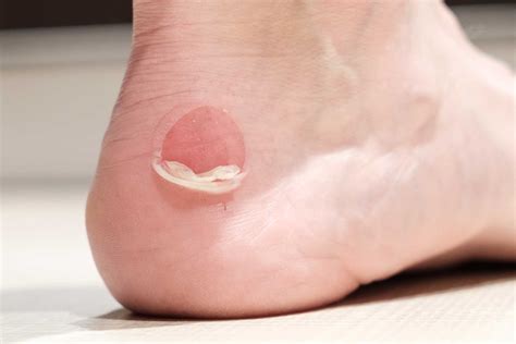 The Factors Behind Painful Blisters on Your Feet