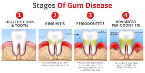 The Factors Leading to the Development of a Mouth Abscess: What You Need to Be Aware of