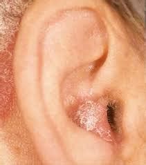 The Fascinating Mystery of Excessive Production of Ear Wax