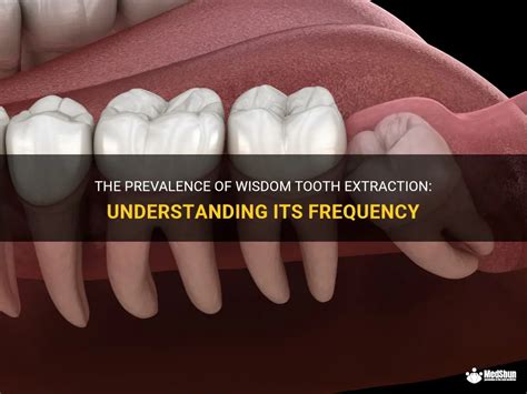 The Frequency of Dreams About Tooth Removal: Prevalence and Significance