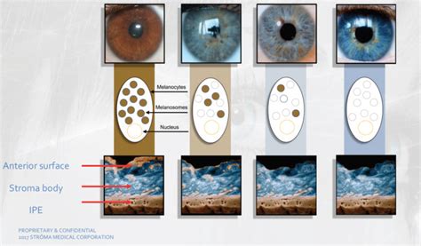 The Future of Iris Color Modification: Opportunities and Ethical Considerations