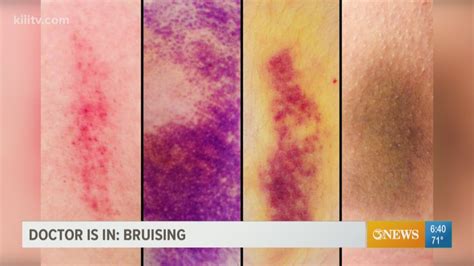 The Height of Bruise Suicide Revealed