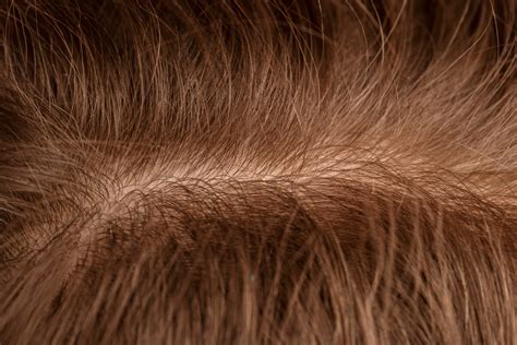 The Hidden Culprits: Uncovering the Causes of Scalp Disease