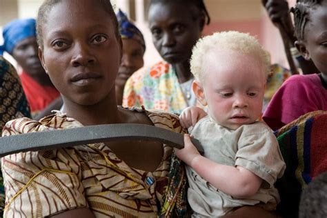 The Historical Significance of Albinism