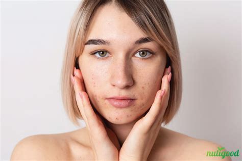 The Impact of Inadequate Skincare Routine on Pimple Formation