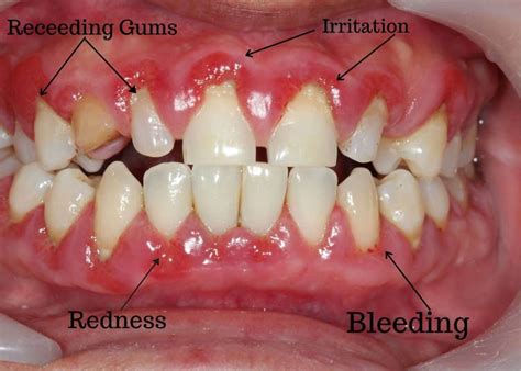 The Impact of Neglecting Proper Oral Care on Tooth Inflammation