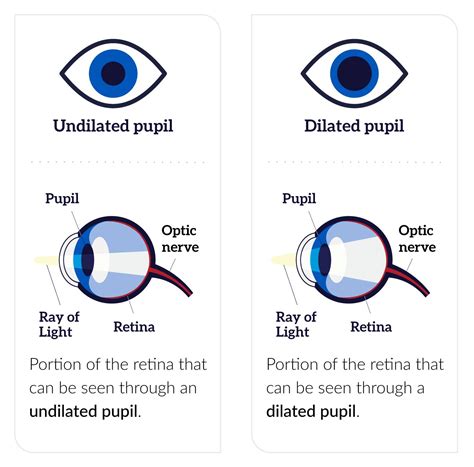 The Impact of Pupil Size on Dream Intensity and Vividness