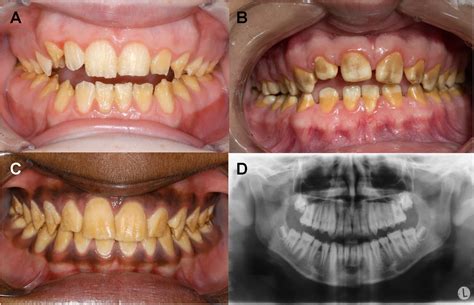 The Influence of Genetic Factors on Dental Enamel Quality