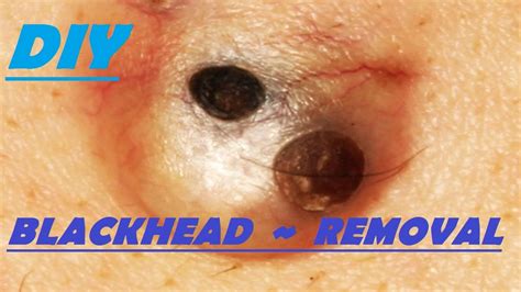 The Intrigue of Blackhead Extraction