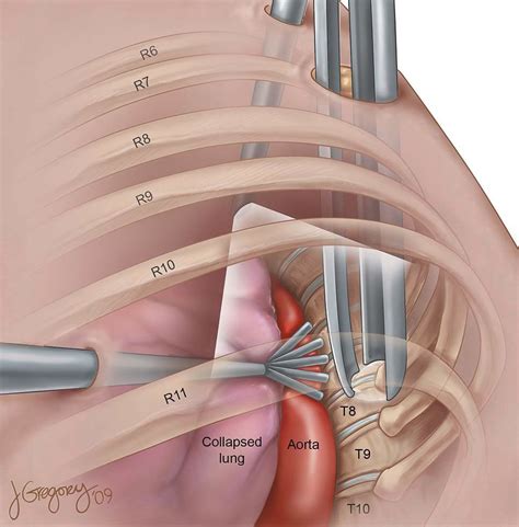 The Intriguing Symbolism behind Dreams of Thoracic Operation