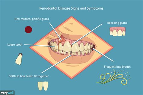 The Link between Diabetes and Gum Conditions