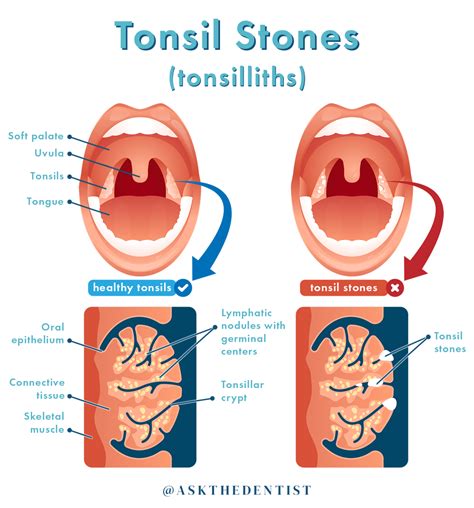 The Link between Stones in Your Mouth and Issues with Communication