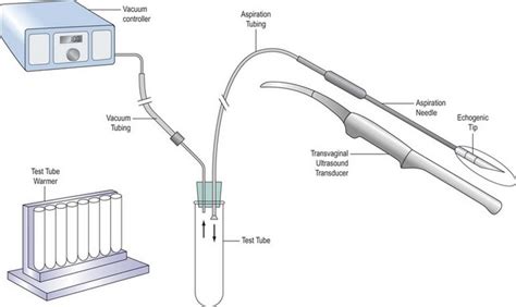 The Path of Assisted Reproduction: Turning Aspirations into Fulfillment