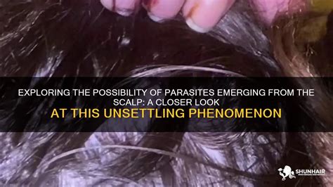 The Phenomenon of Worms Emerging From the Scalp: Unraveling the Mystery