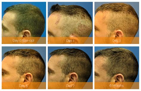 The Procedure: What to Expect during a Hair Restoration Surgery