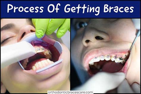 The Process of Getting Braces: Consultation, Placement, and Adjustment