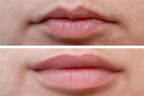 The Pros and Cons of Lip Fillers