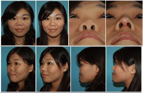 The Psychological Aspects of Obsession with Nose Augmentation