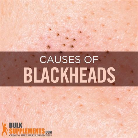 The Psychological Impact of Blackheads