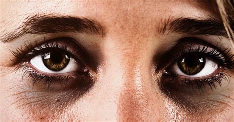 The Psychological Interpretation of Dark Circles around the Eyes in Dreams