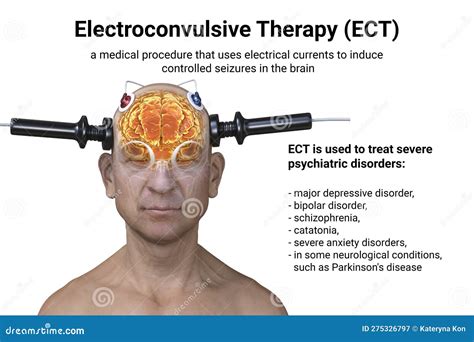 The Psychological Significance of Electroconvulsive Therapy in Dream Analysis