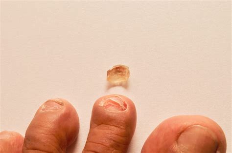 The Psychological Significance of Fingernail Breakage in Dream Analysis