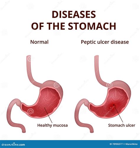 The Pursuit of a Perfectly Clear Abdomen: Is it Normal or Unhealthy?