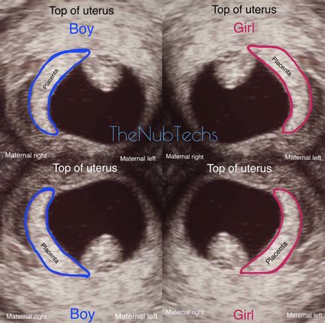 The Ramzi Theory: Determining the Gender of Your Baby through Early Ultrasound