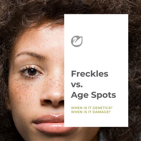 The Relationship Between Freckles and Age