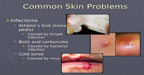 The Role of Bacterial Infections in Formation of Boils