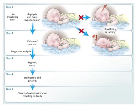 The Role of Cardiopulmonary Resuscitation in Sudden Infant Death Syndrome (SIDS)